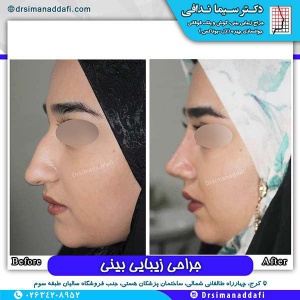جراحی-بینی-85