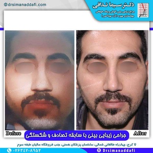 جراحی-بینی-86
