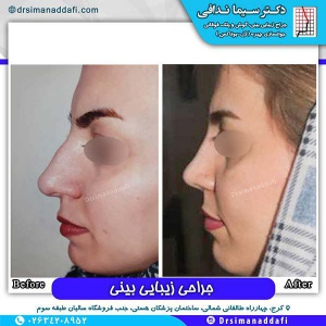 جراحی-بینی-87