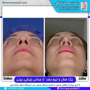 جراحی-بینی-88