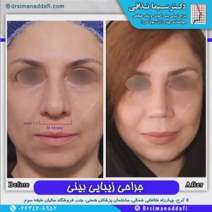 جراحی-بینی-90