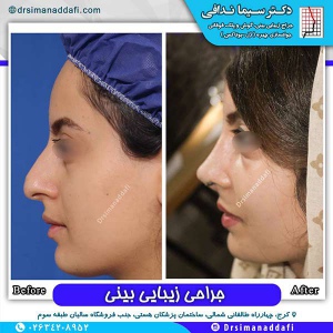 جراحی-بینی-91