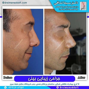 جراحی-بینی-92