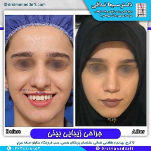 جراحی-بینی-95