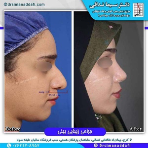 جراحی-بینی-97