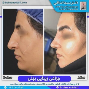 جراحی-بینی-98