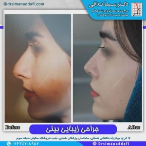 جراحی-بینی-99