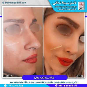 1_-بینی-کرج-32
