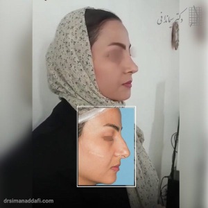 rhinoplasty-326