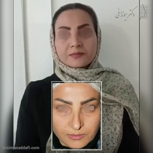rhinoplasty-327