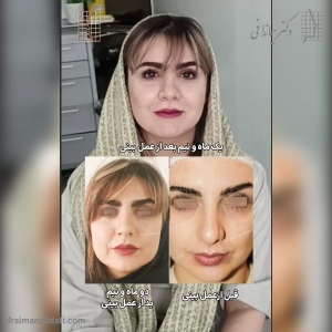 rhinoplasty-330
