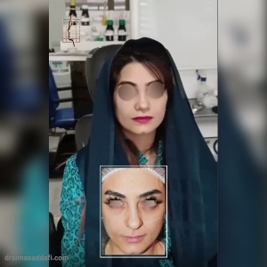 rhinoplasty-332