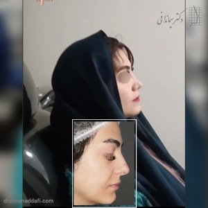 rhinoplasty-333
