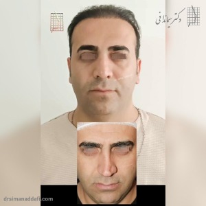 rhinoplasty-334