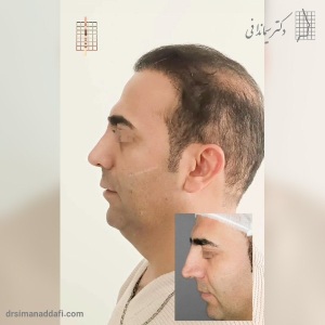 rhinoplasty-335