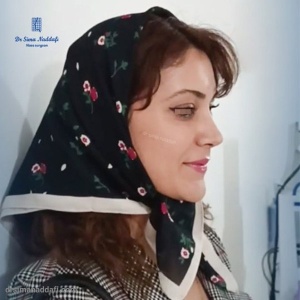 rhinoplasty-336