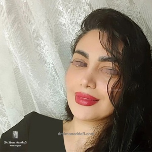 rhinoplasty-339