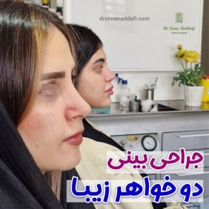 rhinoplasty-340