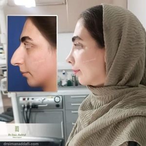 rhinoplasty-341