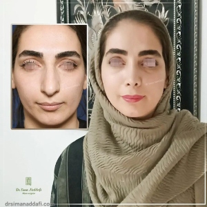 rhinoplasty-342