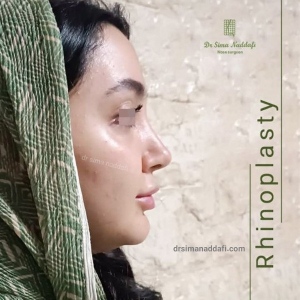 rhinoplasty-343