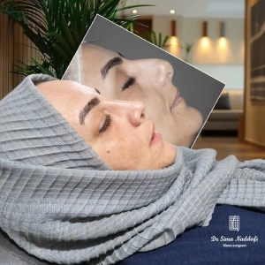 rhinoplasty-344