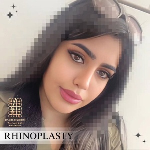 rhinoplasty-351