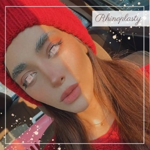 rhinoplasty-355