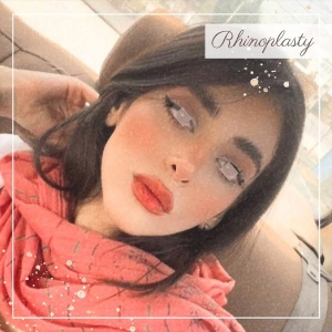 rhinoplasty-359