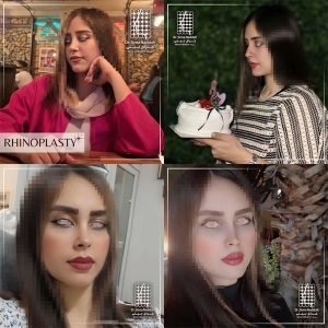 rhinoplasty-361