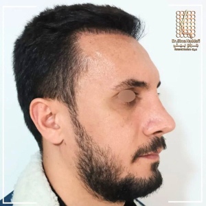 rhinoplasty-362