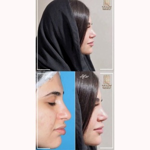 rhinoplasty-363