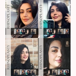 rhinoplasty-365