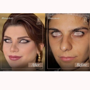 rhinoplasty-366