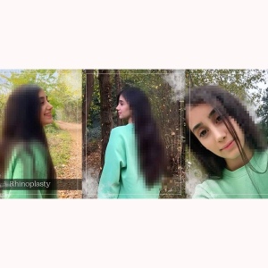 rhinoplasty-367