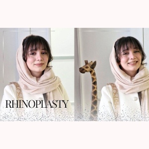 rhinoplasty-369