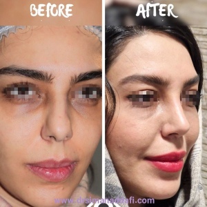 rhinoplasty-372