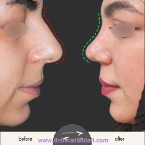 rhinoplasty-375