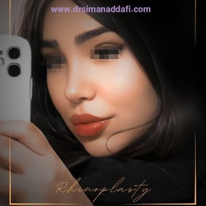 rhinoplasty-378