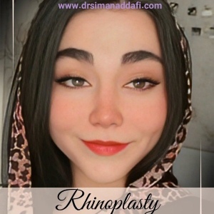 rhinoplasty-380