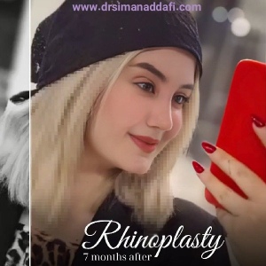 rhinoplasty-381