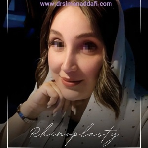 rhinoplasty-384