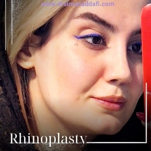 rhinoplasty-385