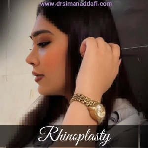 rhinoplasty-386