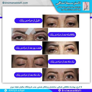 جراحی-پلک-کرج-1