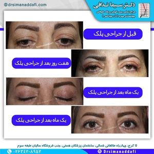 جراحی-پلک-کرج-2