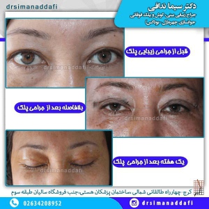 جراحی-پلک-کرج-3