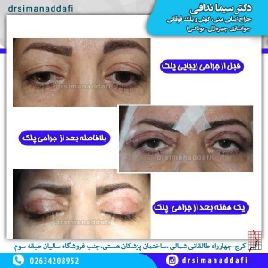 جراحی-پلک-کرج-4