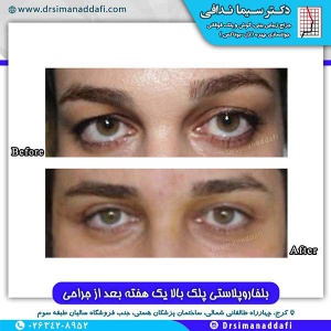 جراحی-پلک-کرج-5