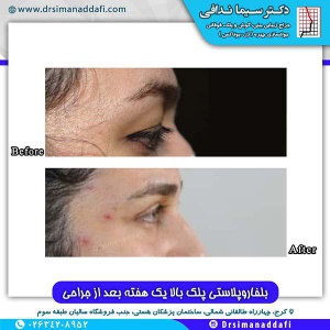 جراحی-پلک-کرج-6